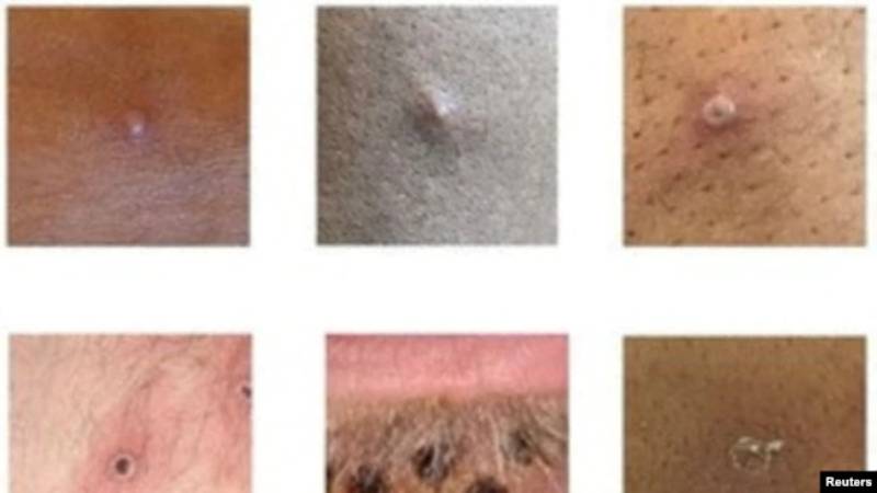 ¿Cómo son las lesiones que provoca la viruela del mono?