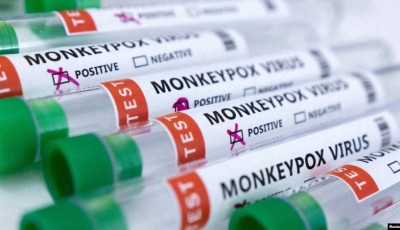 Perú reporta primera muerte relacionada a la viruela del mono