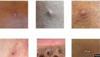 ¿Cómo son las lesiones que provoca la viruela del mono?