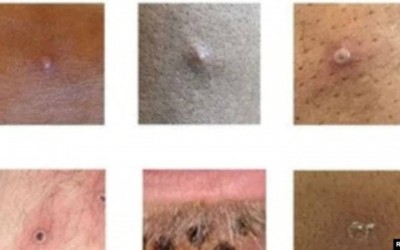 ¿Cómo son las lesiones que provoca la viruela del mono?