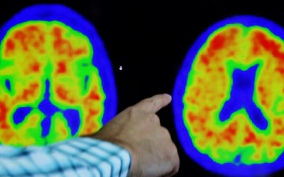 fármaco contra el Alzheimer de Eisai y Biogen